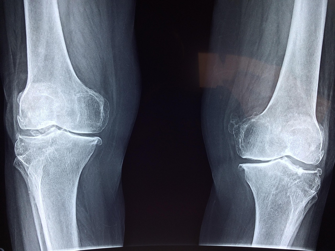 Tips Cegah Osteoporosis: Cukupi Kebutuhan Vitamin D dan Rutin Berolahraga