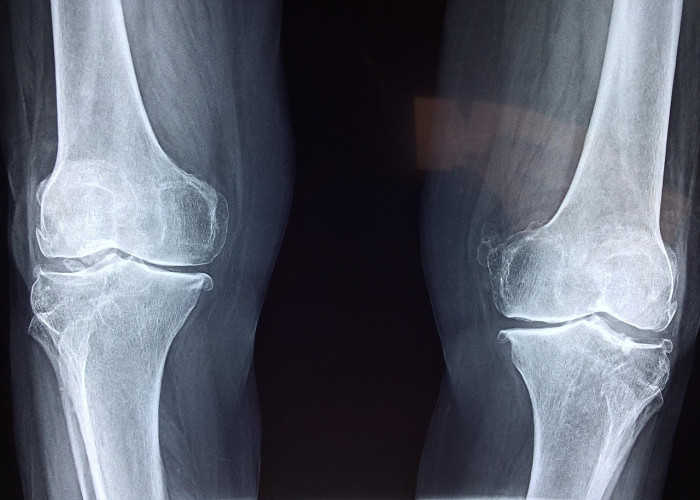 Tips Cegah Osteoporosis: Cukupi Kebutuhan Vitamin D dan Rutin Berolahraga